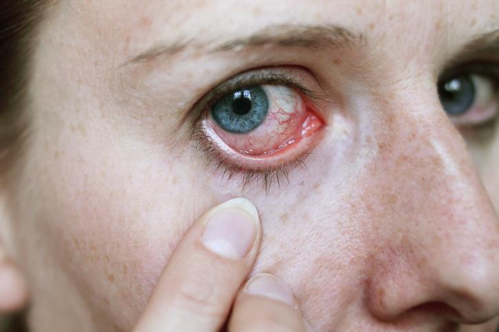Herpes Oculares Síntomas Principales Blog De Clínica Baviera 